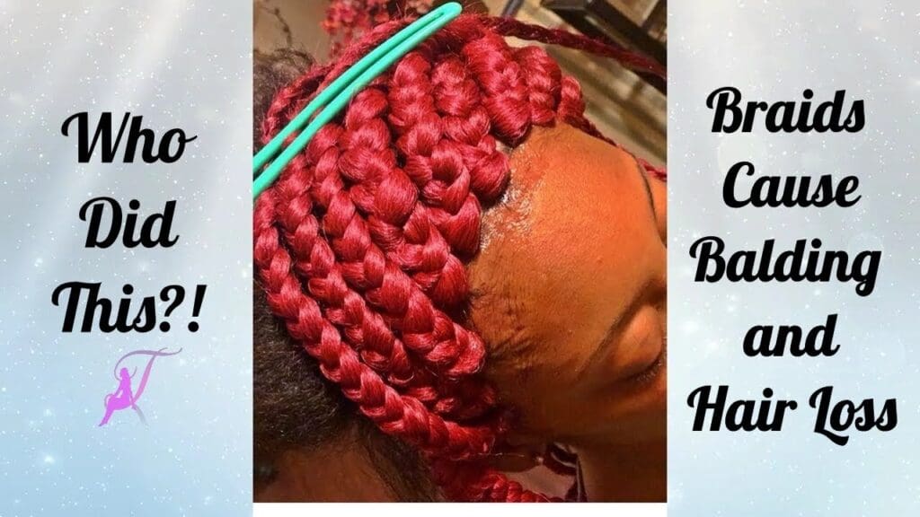Who Did This?! Microbraiding Hairstyles Cause Hair Loss and Balding